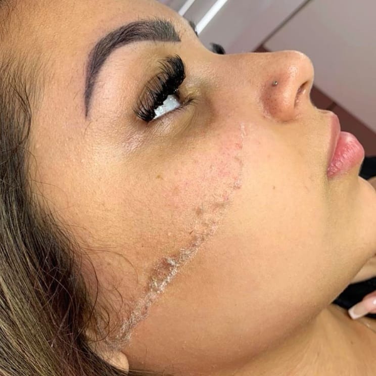 DERMAPLANING